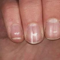Причины неровных ногтей на руках и их лечение Поверхность ногтя ребристая