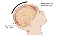 Как определить, есть ли сотрясение головного мозга у ребенка: первые признаки Чем опасно сотрясение мозга у подростка