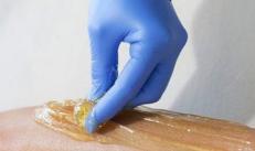 Sugaring applied to the skin