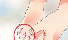 Maceração da pele: rugas nos dedos por causa da água ou sintoma de uma doença grave