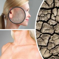 皮膚の乾皮症の原因。 乾皮症の治療。 乾皮症の局所治療