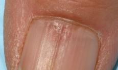 Sulcos de Beau-Reil - sulcos transversais das unhas, ou sulcos transversais (ranhuras de Beau ou linhas de Beau-Reil), surgem devido à influência de vários fatores, na maioria das vezes endógenos, na matriz