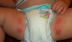 Eruzione da pannolino all'inguine nei neonati Eruzione da pannolino nei bambini nel trattamento dell'inguine